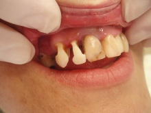 Restorativna stomatologija